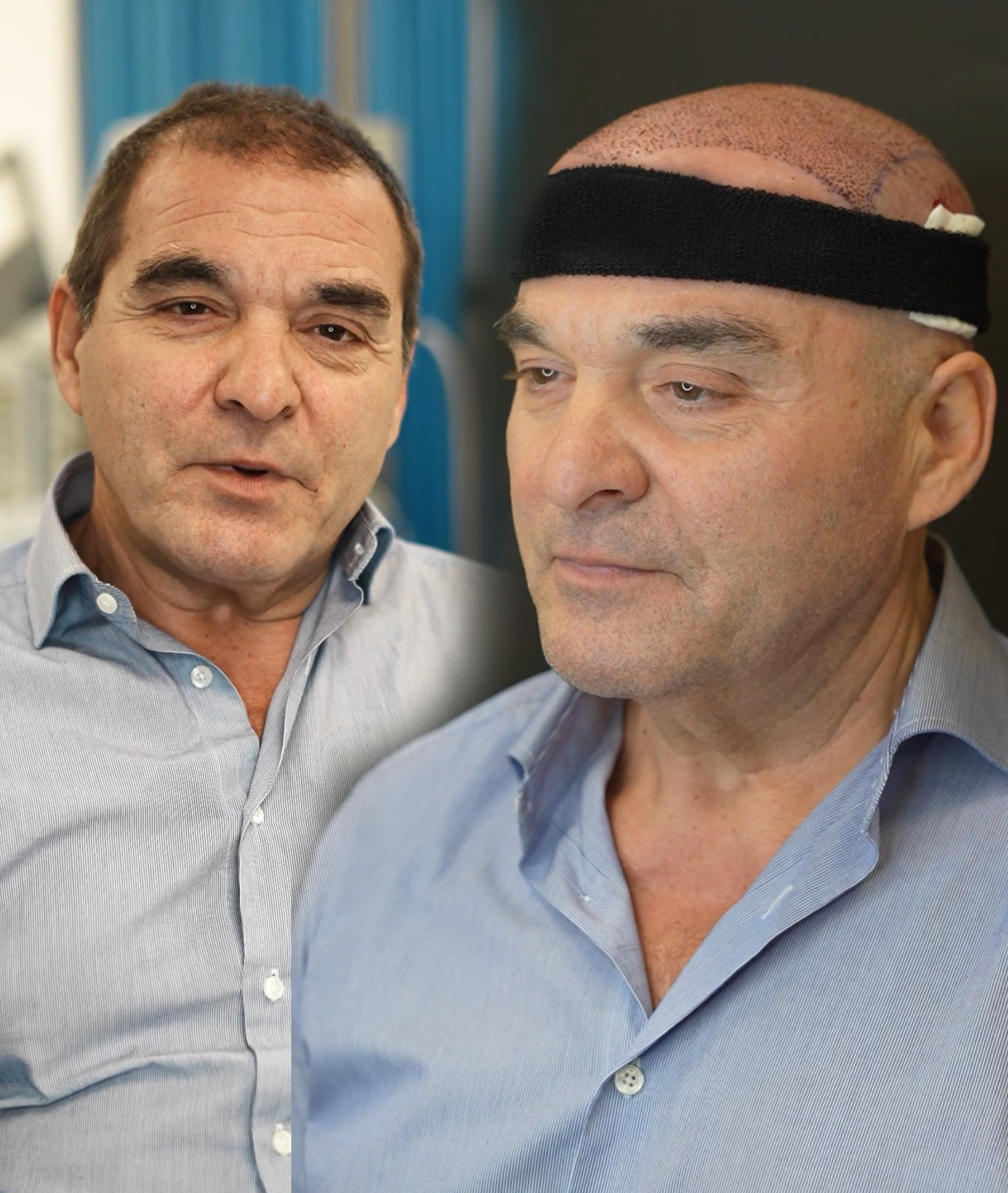 Hair transplant result