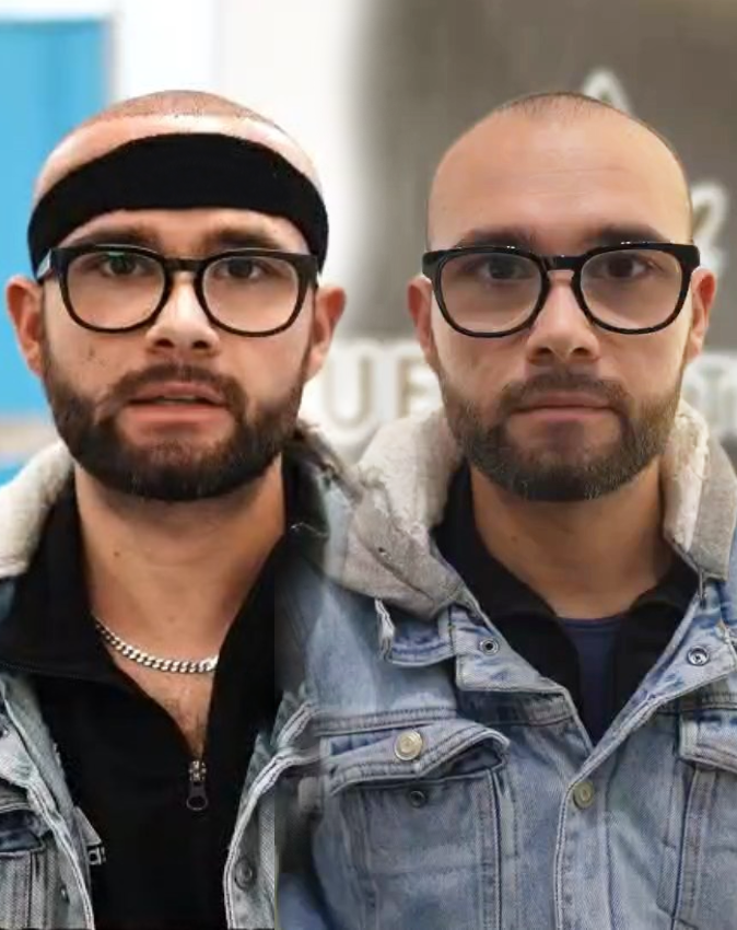 Hair transplant result