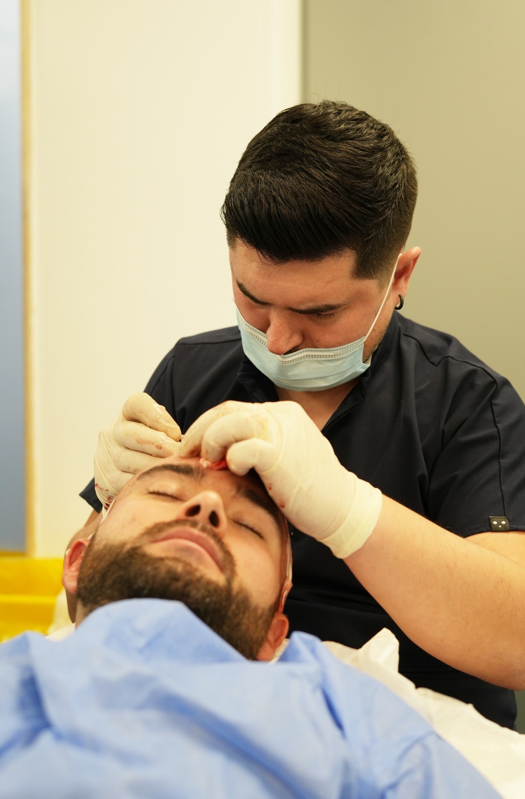 Hair transplant result